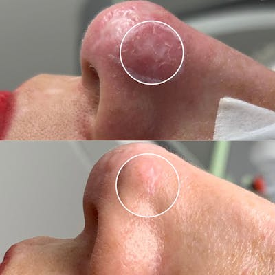 UltraPulse Laser Before & After Gallery - Patient 110888 - Image 1