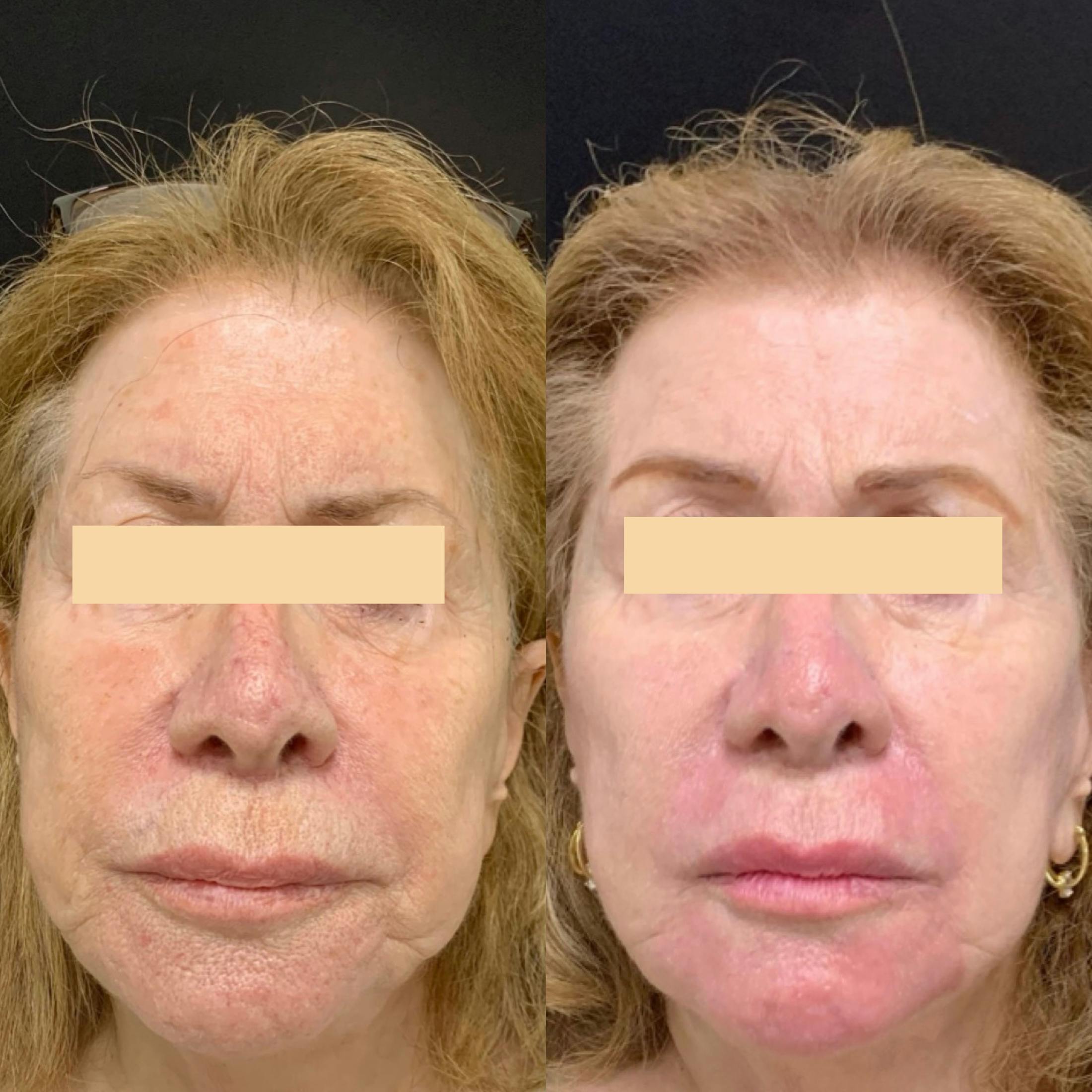 UltraPulse Laser Before & After Gallery - Patient 266198 - Image 1