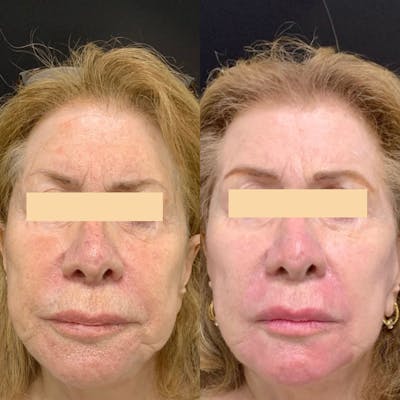 UltraPulse Laser Before & After Gallery - Patient 266198 - Image 1