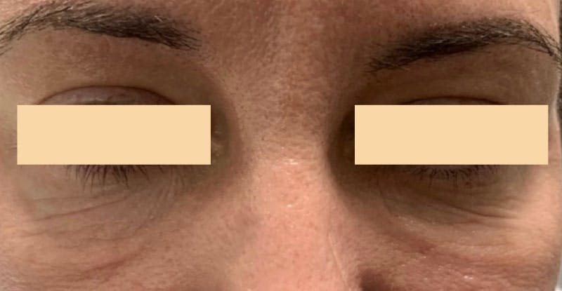 procedure