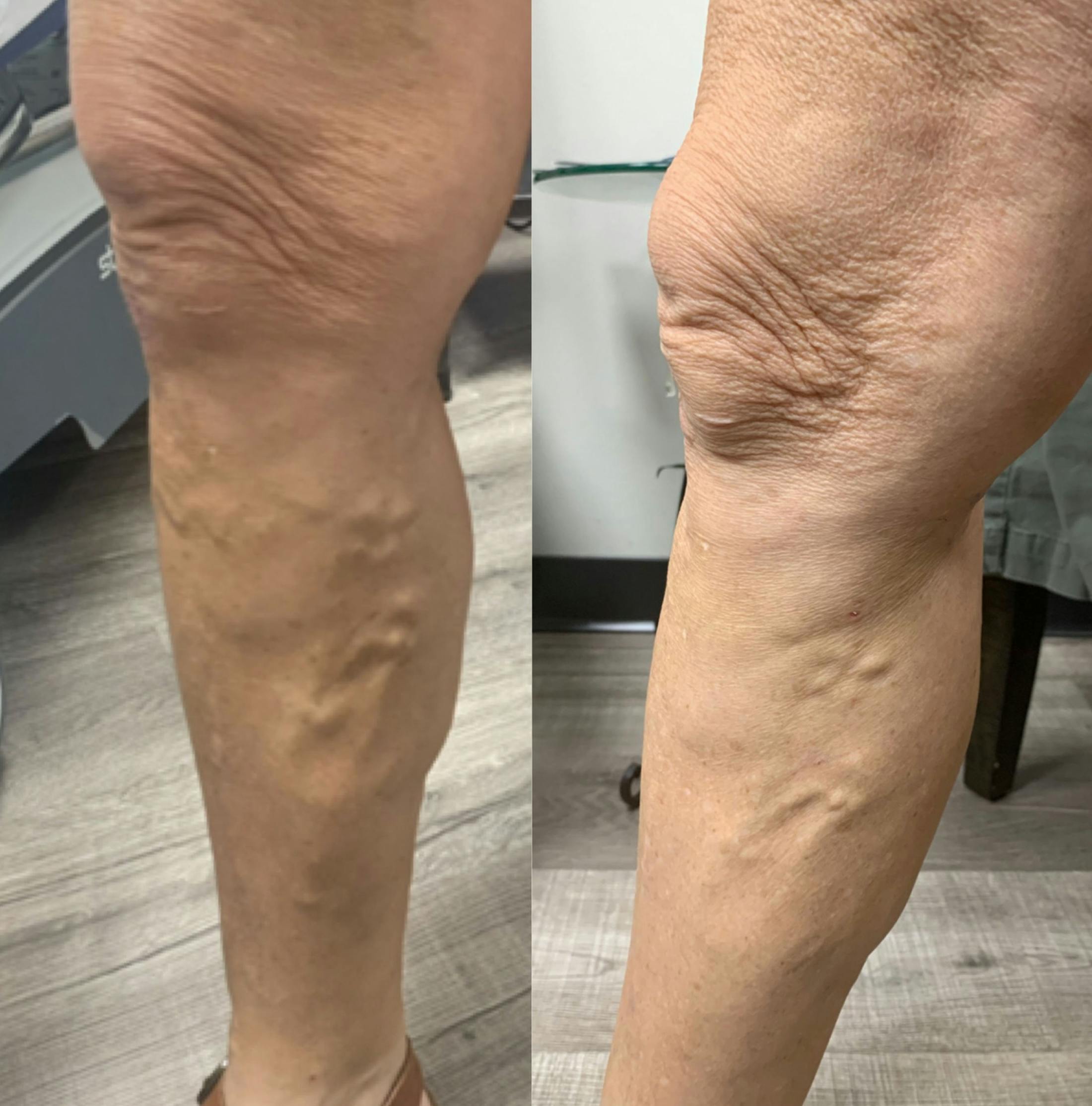 Vein Ablation Before & After Gallery - Patient 133892 - Image 1