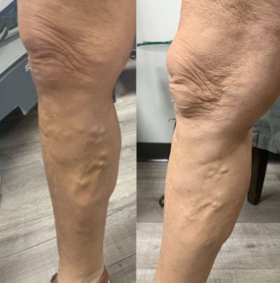 Vein Ablation Before & After Gallery - Patient 133892 - Image 1