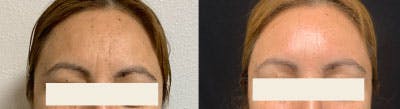BOTOX Before & After Gallery - Patient 232163 - Image 1