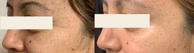 BOTOX Before & After Gallery - Patient 419867 - Image 1