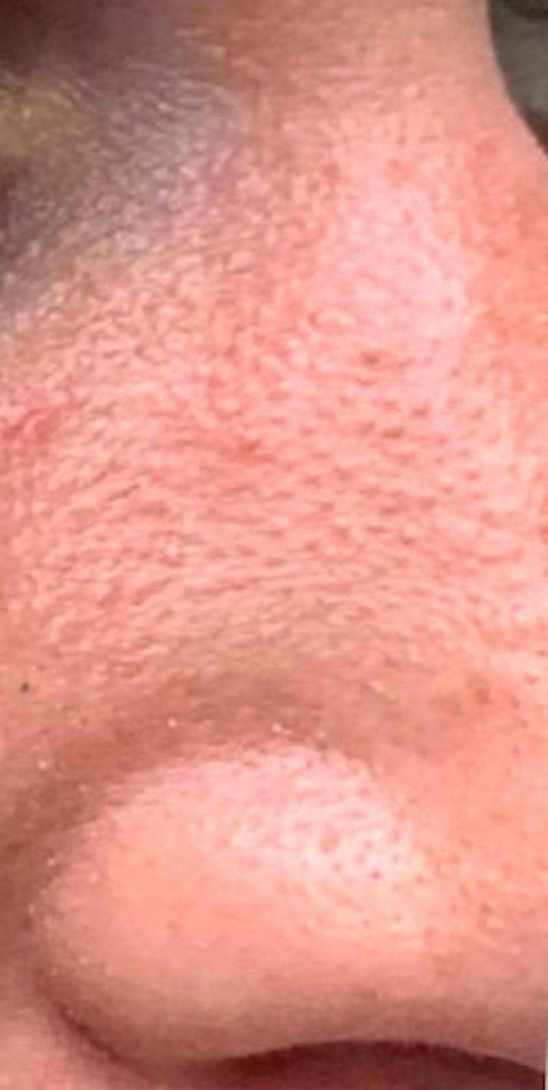 YAG Laser Before & After Gallery - Patient 313725 - Image 2