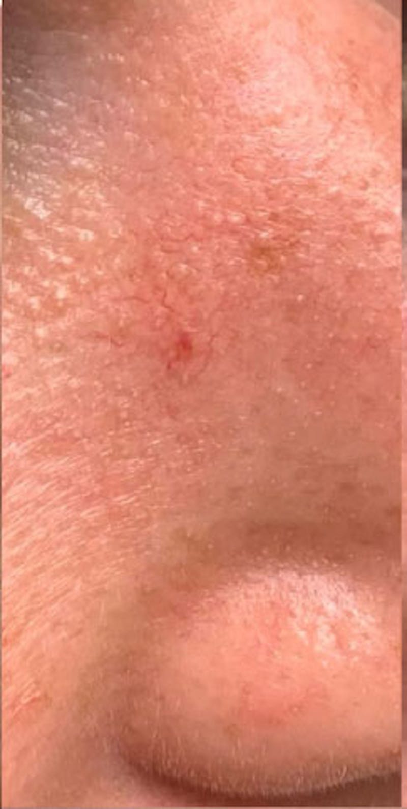 YAG Laser Before & After Gallery - Patient 313725 - Image 1