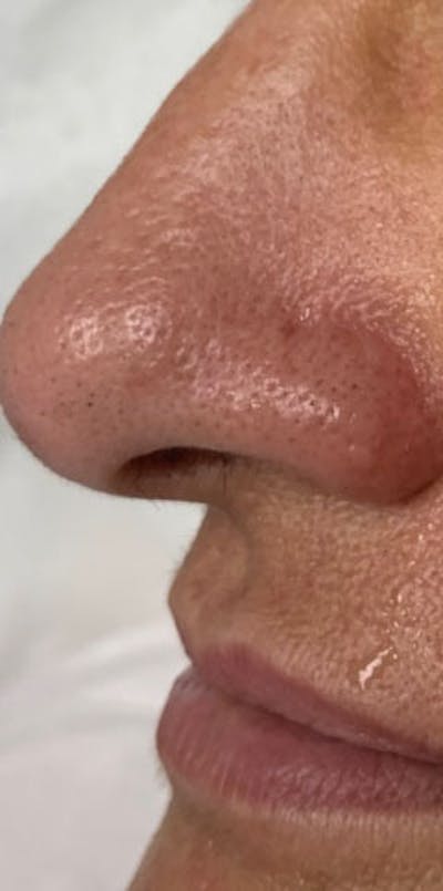 YAG Laser Before & After Gallery - Patient 213965 - Image 2