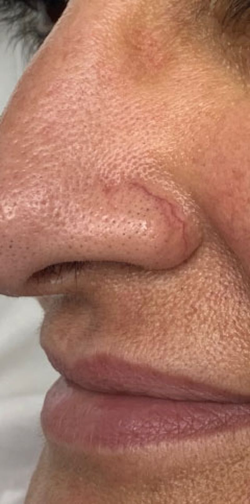 YAG Laser Before & After Gallery - Patient 213965 - Image 1