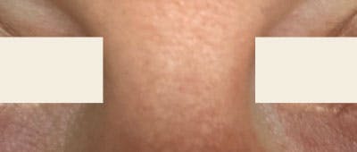 YAG Laser Before & After Gallery - Patient 355071 - Image 2