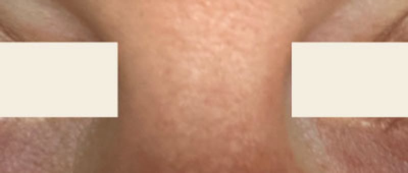 YAG Laser Before & After Gallery - Patient 355071 - Image 2