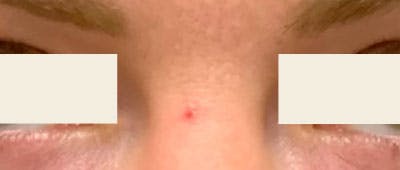 YAG Laser Before & After Gallery - Patient 355071 - Image 1