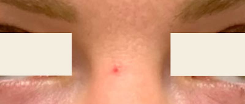 YAG Laser Before & After Gallery - Patient 355071 - Image 1