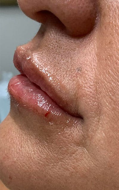 Lip Fillers Before & After Gallery - Patient 168675 - Image 2