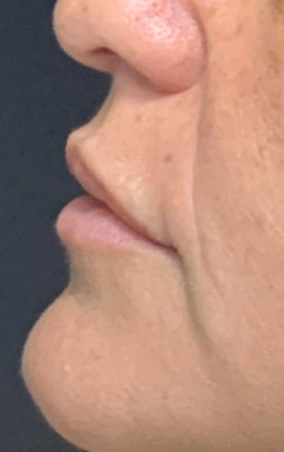 Lip Fillers Before & After Gallery - Patient 168675 - Image 1