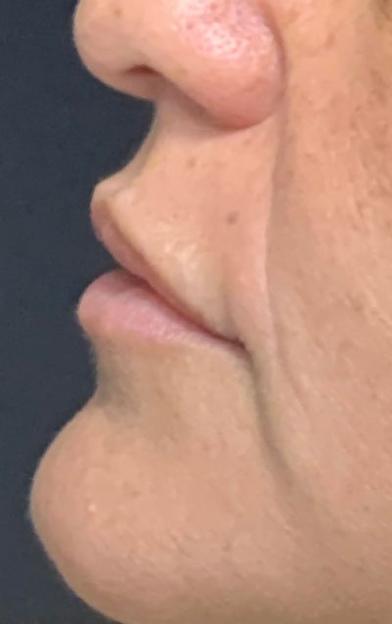 Lip Fillers Before & After Gallery - Patient 168675 - Image 1