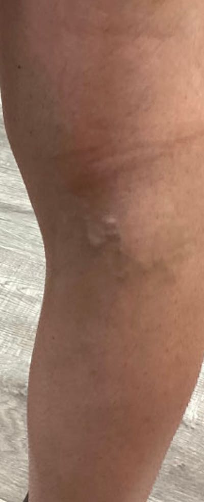 Vein Treatment Before & After Gallery - Patient 162520 - Image 2