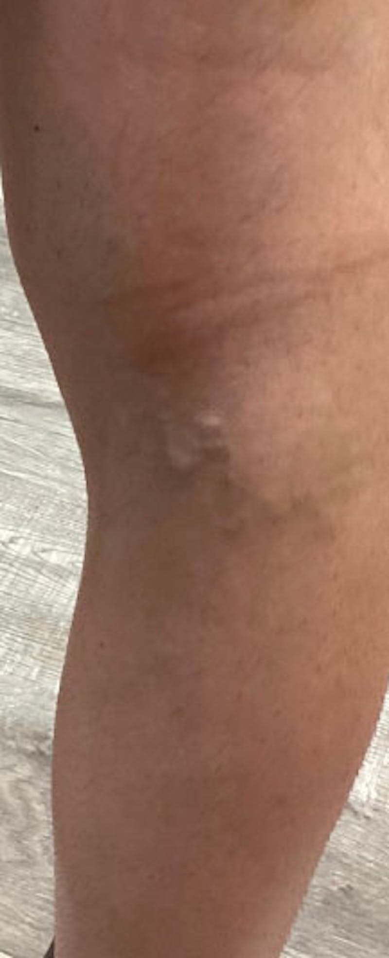 Vein Treatment Before & After Gallery - Patient 162520 - Image 2