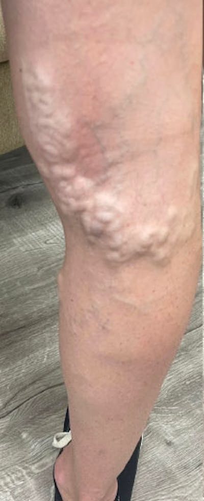 Vein Treatment Before & After Gallery - Patient 162520 - Image 1