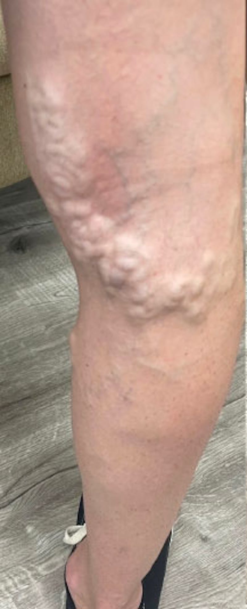 Vein Treatment Before & After Gallery - Patient 162520 - Image 1