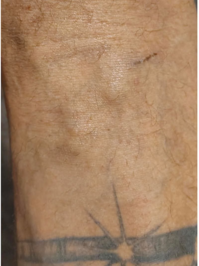 Vein Treatment Before & After Gallery - Patient 208385 - Image 2