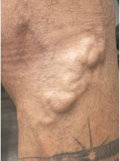 Vein Treatment Before & After Gallery - Patient 208385 - Image 1