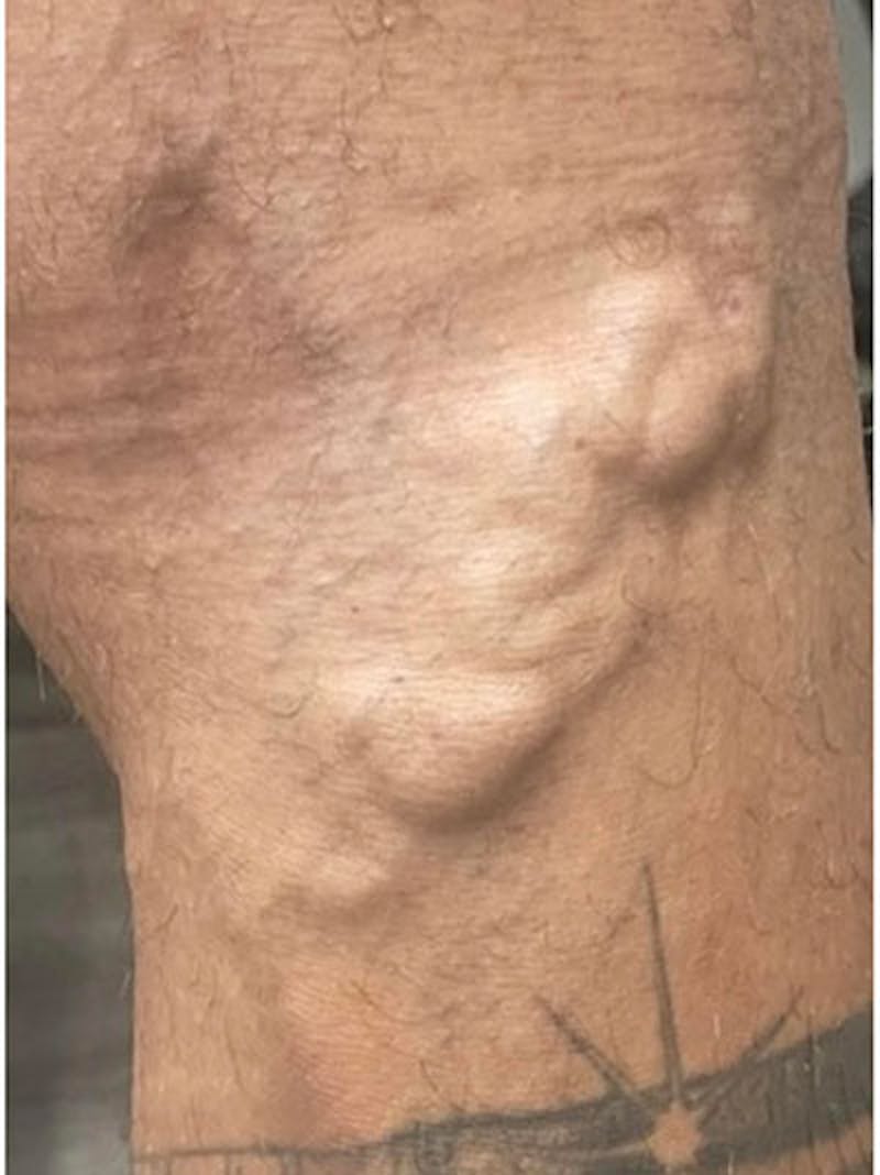 Vein Treatment Before & After Gallery - Patient 208385 - Image 1