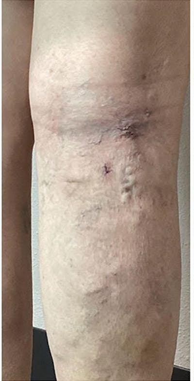 Vein Treatment Before & After Gallery - Patient 154508 - Image 2