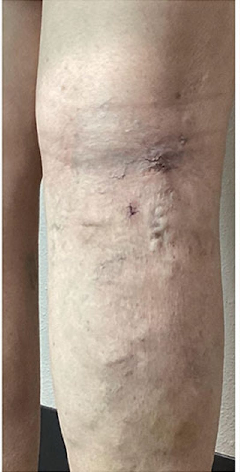 Phlebectomy Before & After Gallery - Patient 426304 - Image 2