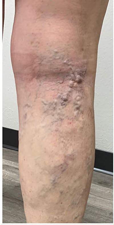 Vein Treatment Before & After Gallery - Patient 154508 - Image 1