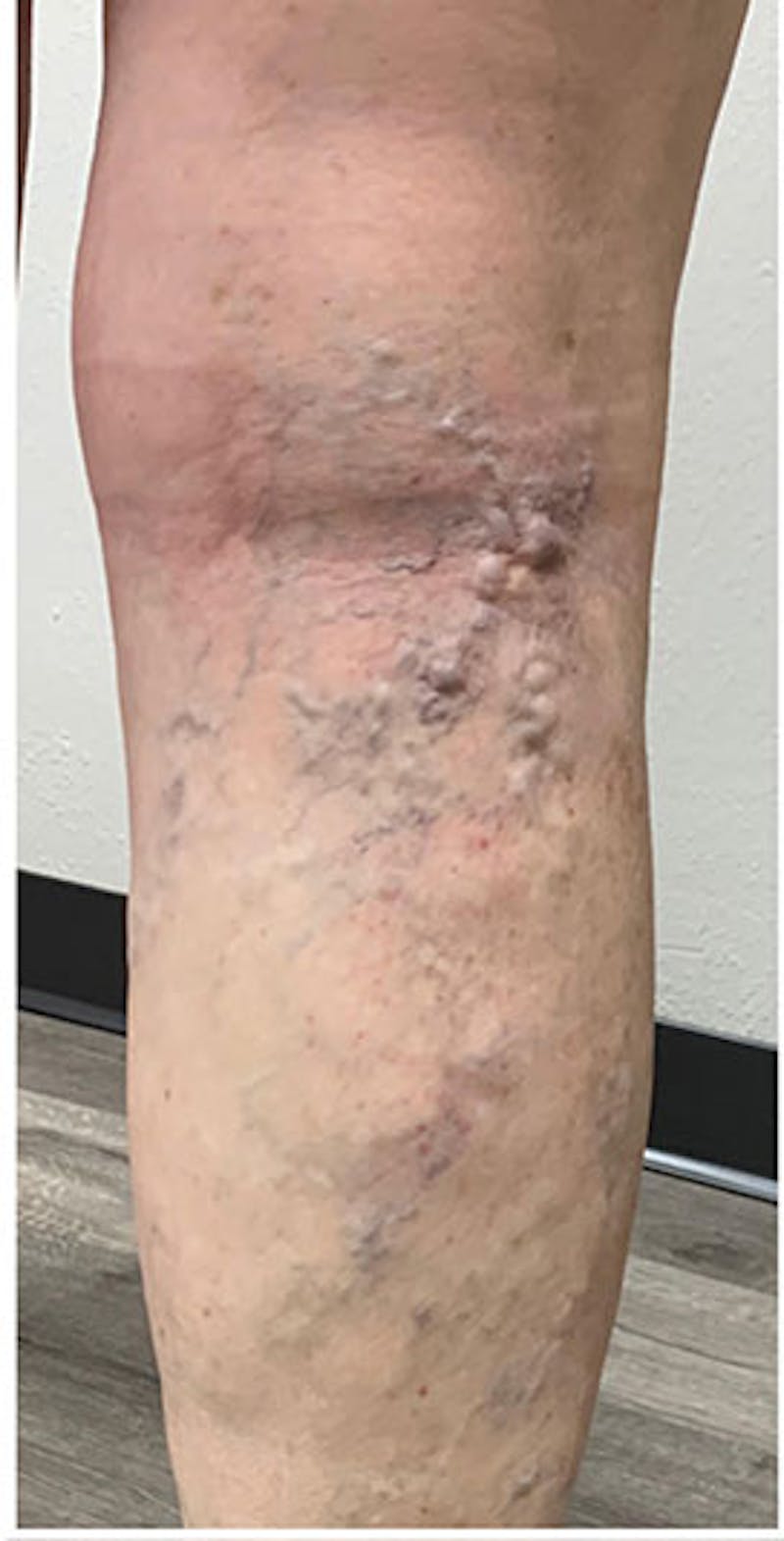Phlebectomy Before & After Gallery - Patient 426304 - Image 1