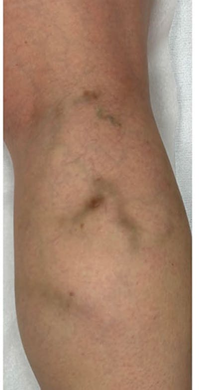 Vein Treatment Before & After Gallery - Patient 408914 - Image 2
