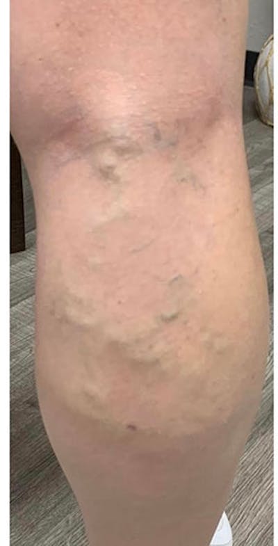 Vein Treatment Before & After Gallery - Patient 408914 - Image 1