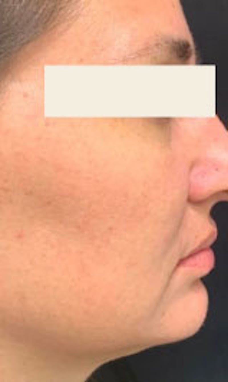 IPL Before & After Gallery - Patient 281687 - Image 2