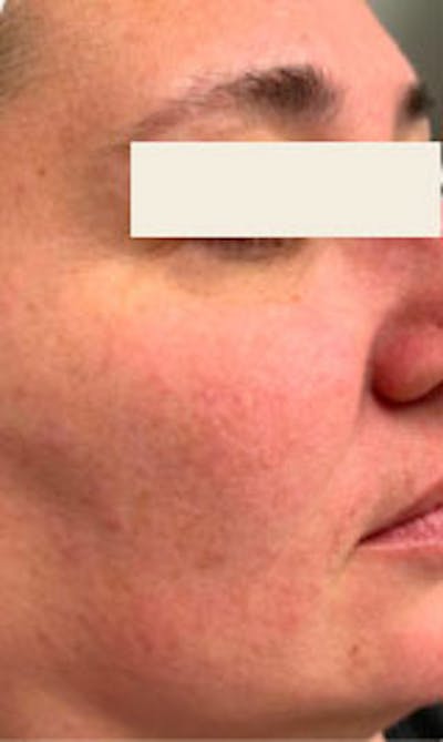 IPL Before & After Gallery - Patient 281687 - Image 1