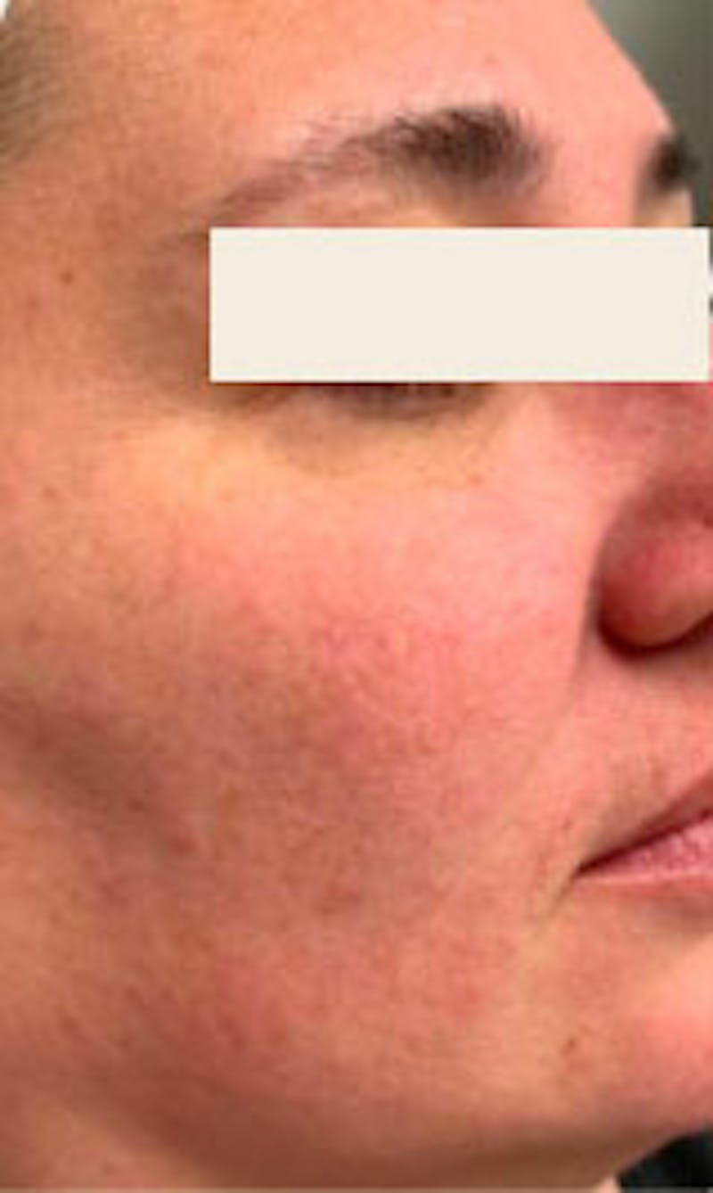 IPL Before & After Gallery - Patient 281687 - Image 1