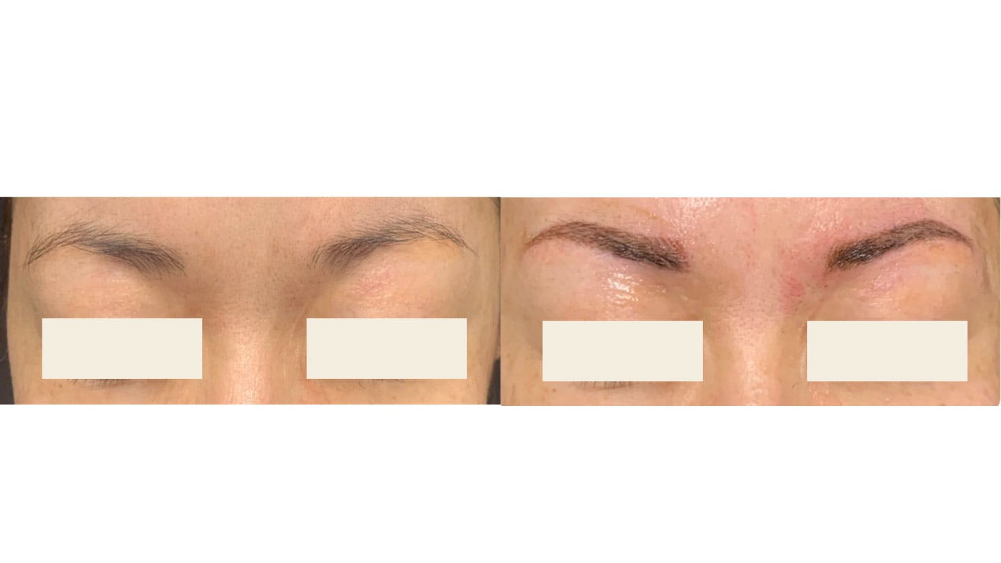 Microblading Before & After Gallery - Patient 402008 - Image 1