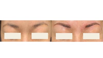 Microblading Before & After Gallery - Patient 402008 - Image 1