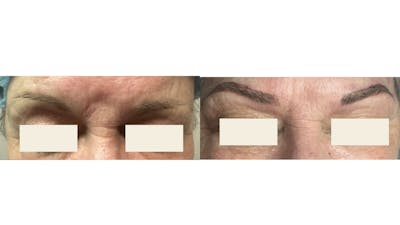 Microblading Before & After Gallery - Patient 297104 - Image 1