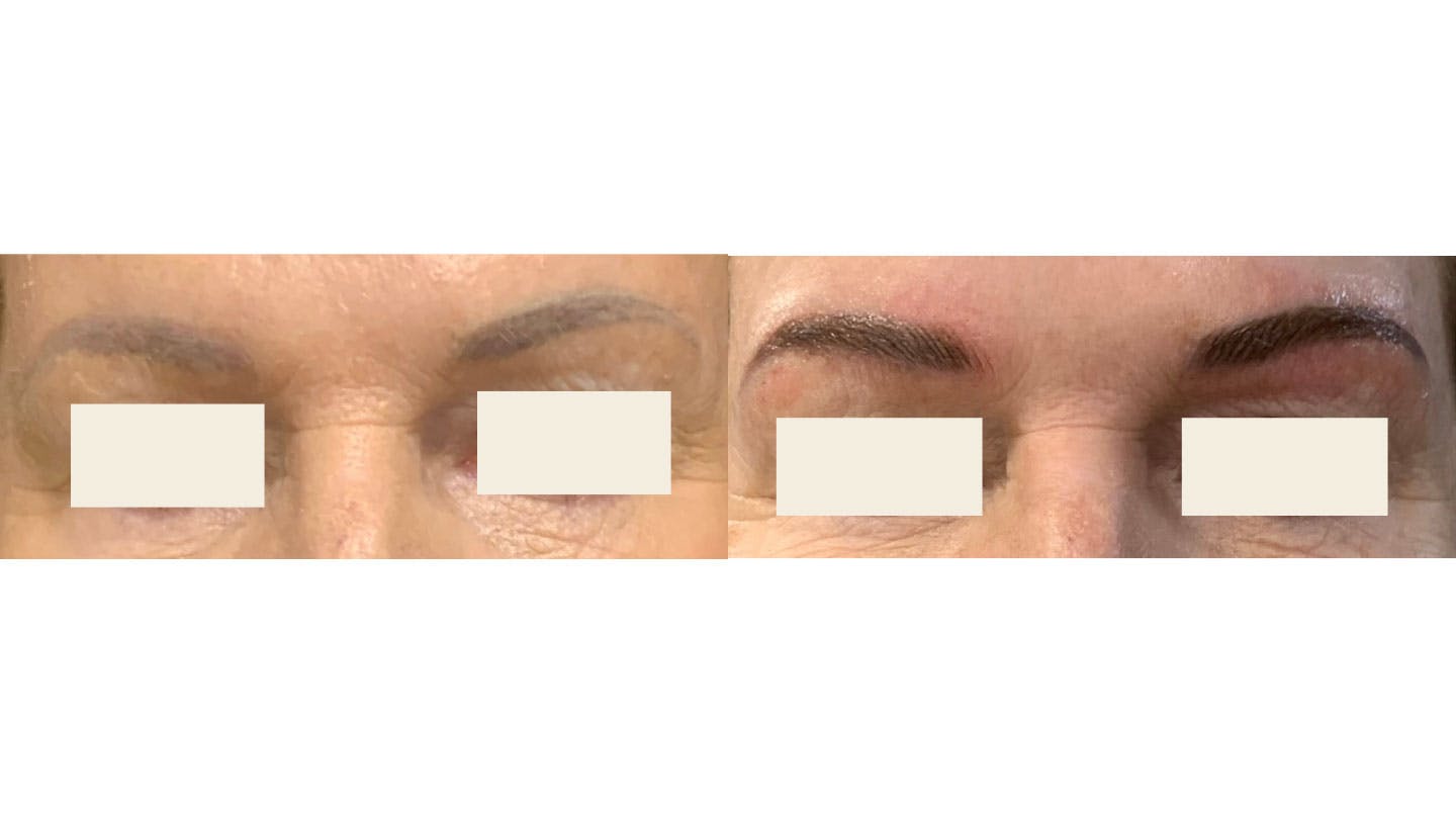 Microblading Before & After Gallery - Patient 414458 - Image 1