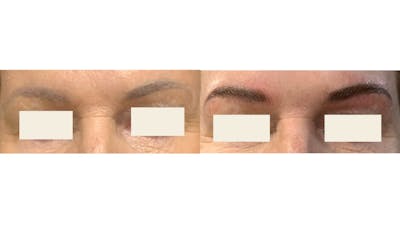 Microblading Before & After Gallery - Patient 414458 - Image 1