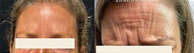 BOTOX Before & After Gallery - Patient 109689 - Image 1