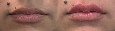 BOTOX Before & After Gallery - Patient 280275 - Image 1