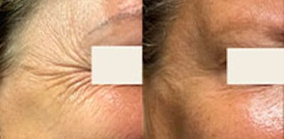BOTOX Before & After Gallery - Patient 256265 - Image 1