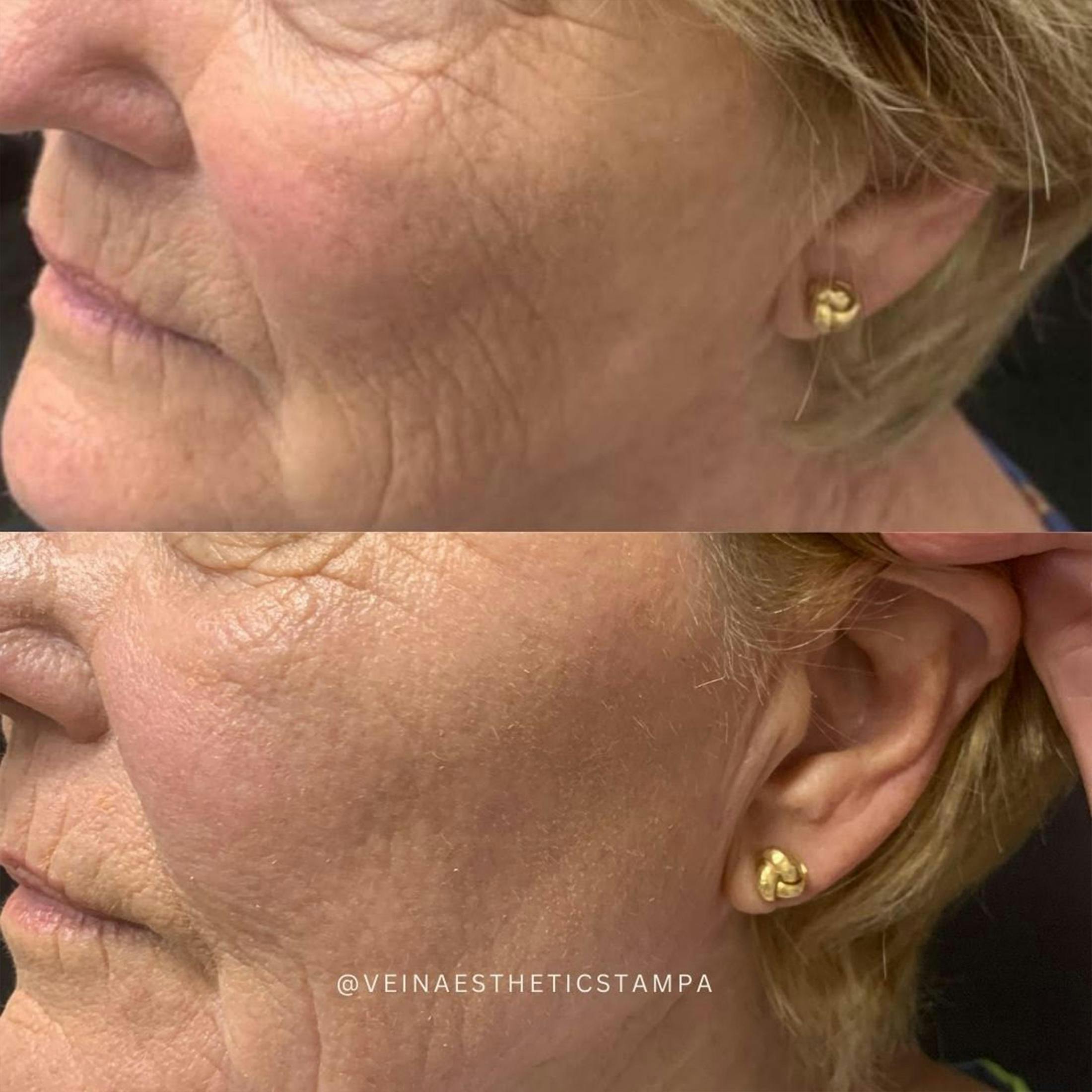 UltraPulse Laser Before & After Gallery - Patient 889845 - Image 1