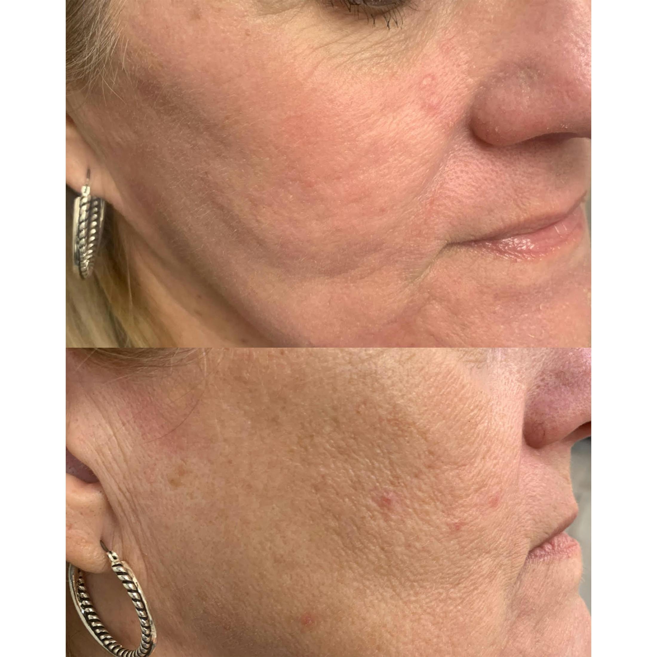 UltraPulse Laser Before & After Gallery - Patient 503226 - Image 1