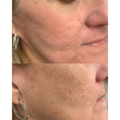 UltraPulse Laser Before & After Gallery - Patient 503226 - Image 1