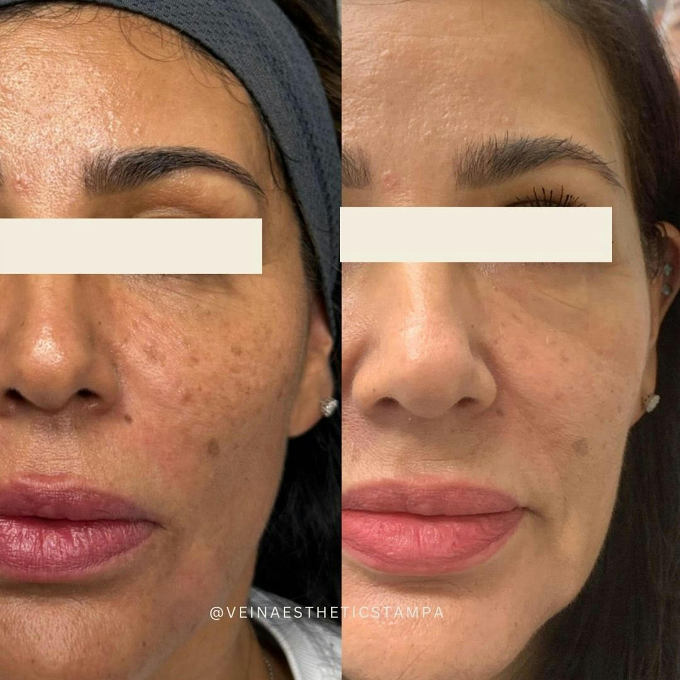 UltraPulse Laser Before & After Gallery - Patient 324307 - Image 1