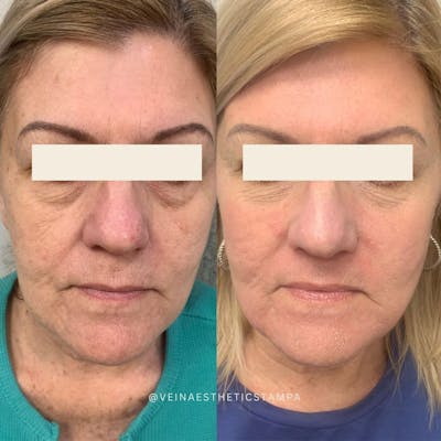 UltraPulse Laser Before & After Gallery - Patient 385851 - Image 1