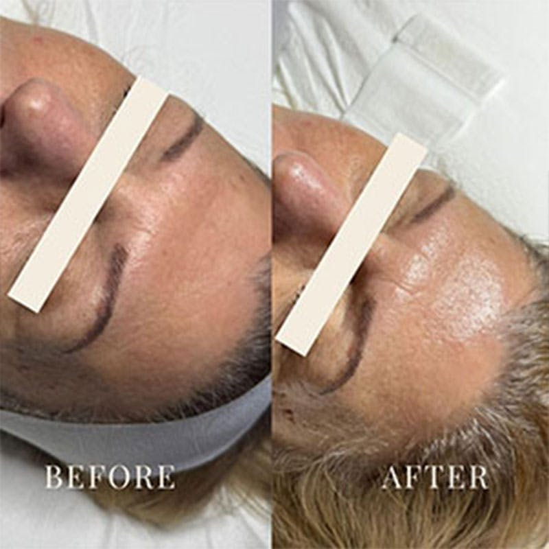Hydrafacial MD Elite Before & After Gallery - Patient 254012 - Image 1