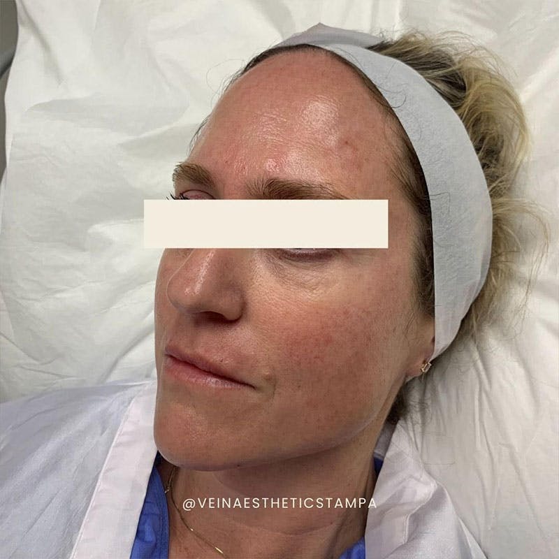Hydrafacial MD Elite Before & After Gallery - Patient 333459 - Image 1